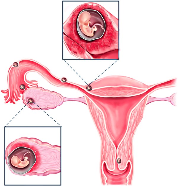 Причины и последствия внематочной беременности