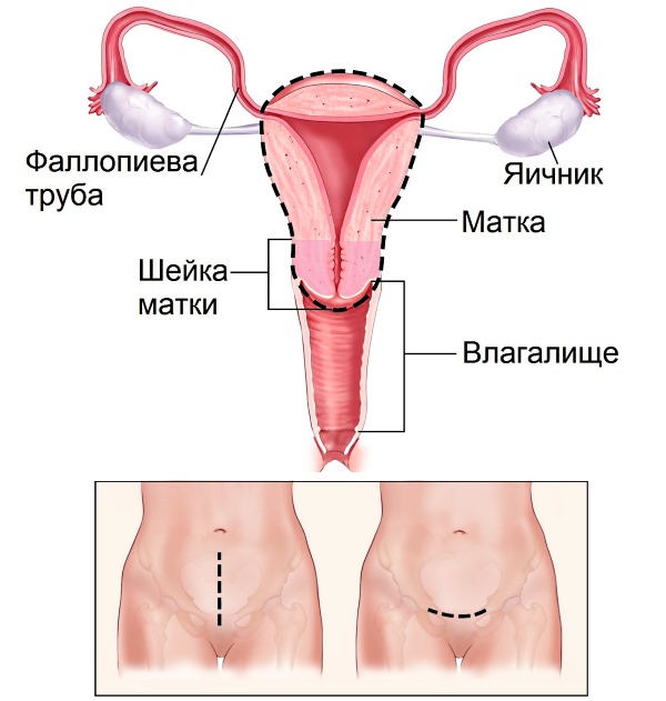 Ускладнення після операції видалення матки, наслідки ампутації матки з яєчниками