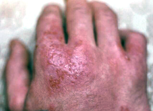 Алергічний дерматит