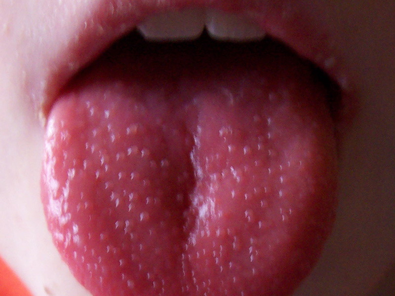 Язик при скарлатині