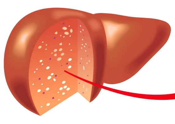 Причини і симптоми жирового гепатозу печінки