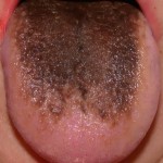 Причини коричневого, жовтого нальоту на язиці