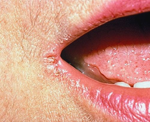 Причини появи тріщин в куточках губ