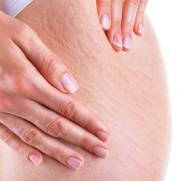 Крем і засоби від розтяжок під час вагітності, як уникнути їх поява