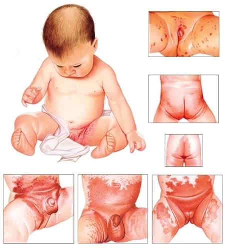 Чим лікувати пелюшковий дерматит у дитини